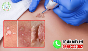 Địa chỉ điều trị sùi mào gà hậu giang