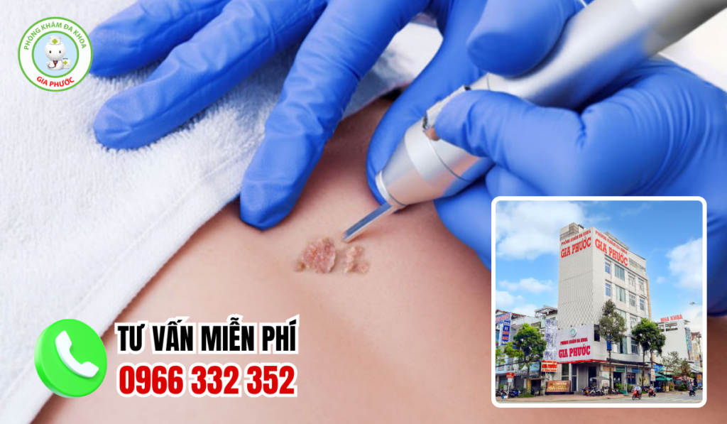 Địa chỉ điều trị sùi mào gà sóc trăng