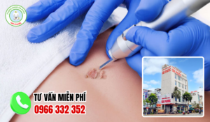 Địa chỉ điều trị sùi mào gà sóc trăng