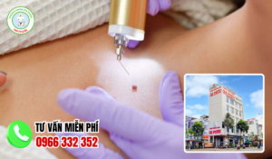 Địa chỉ điều trị sùi mào gà trà vinh