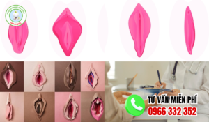 Hình ảnh môi bé phì đại