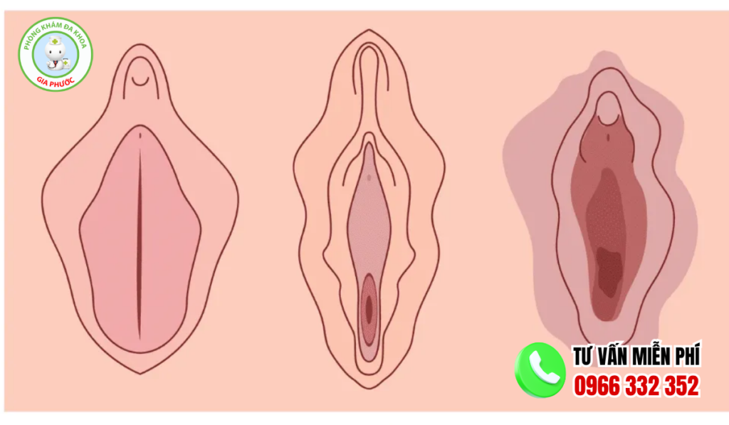 Hình ảnh môi bé phì đại