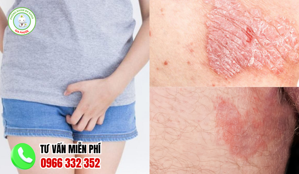 Hình ảnh ngứa vùng kín