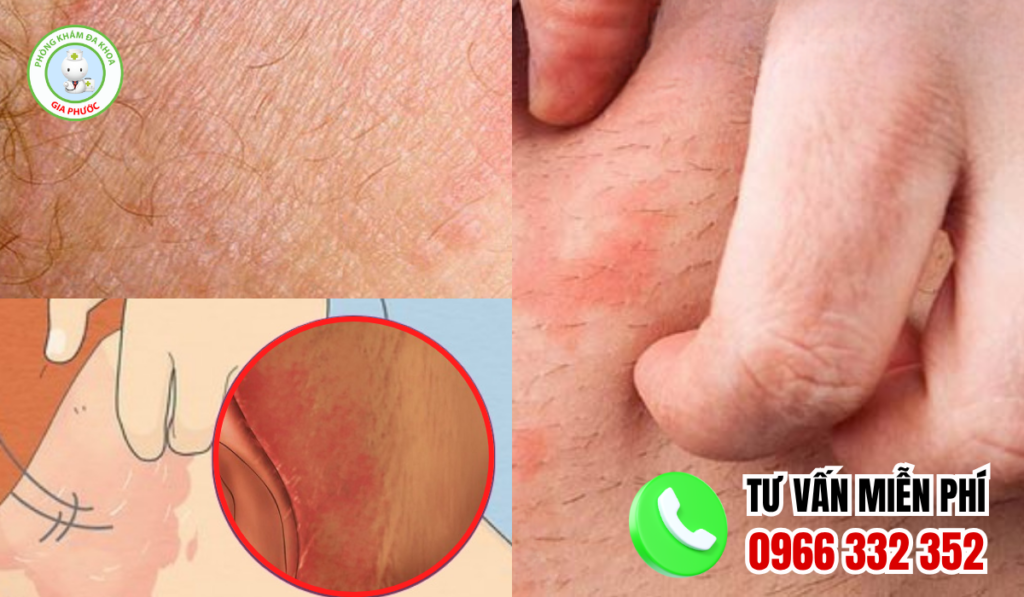 Hình ảnh ngứa vùng kín