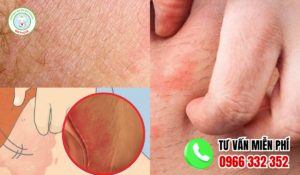 Hình ảnh ngứa vùng kín