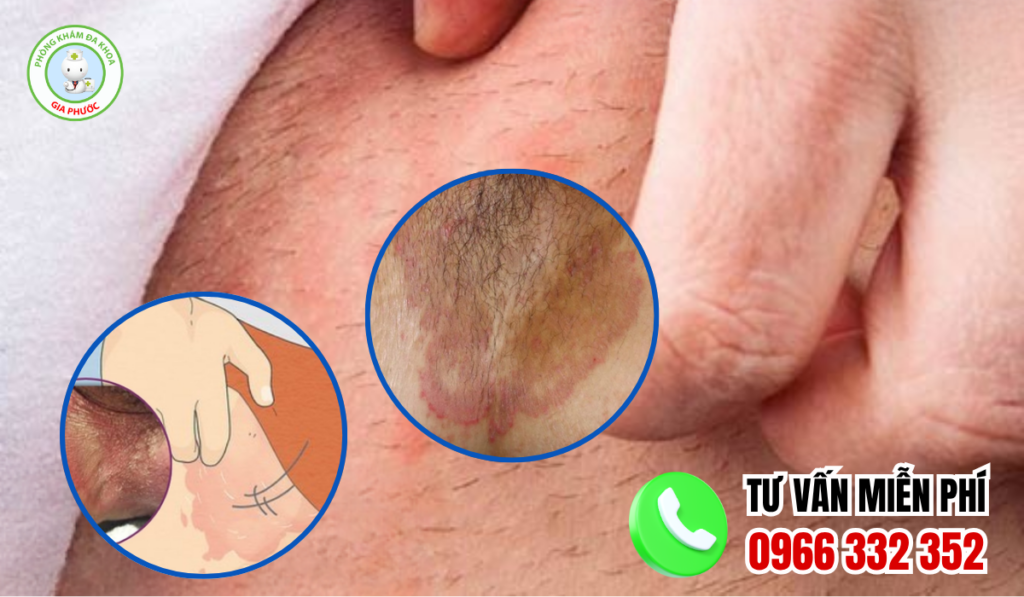Hình ảnh ngứa vùng kín chân thực