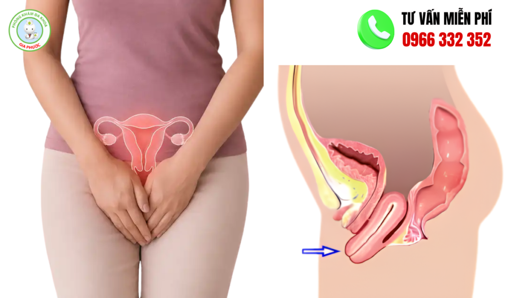 Hình ảnh sa tử cung độ 1 3D