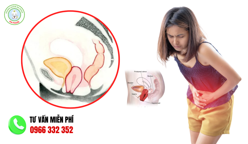 Hình ảnh sa tử cung độ 1 chi tiết