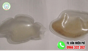 Hình ảnh tinh trùng vón cục