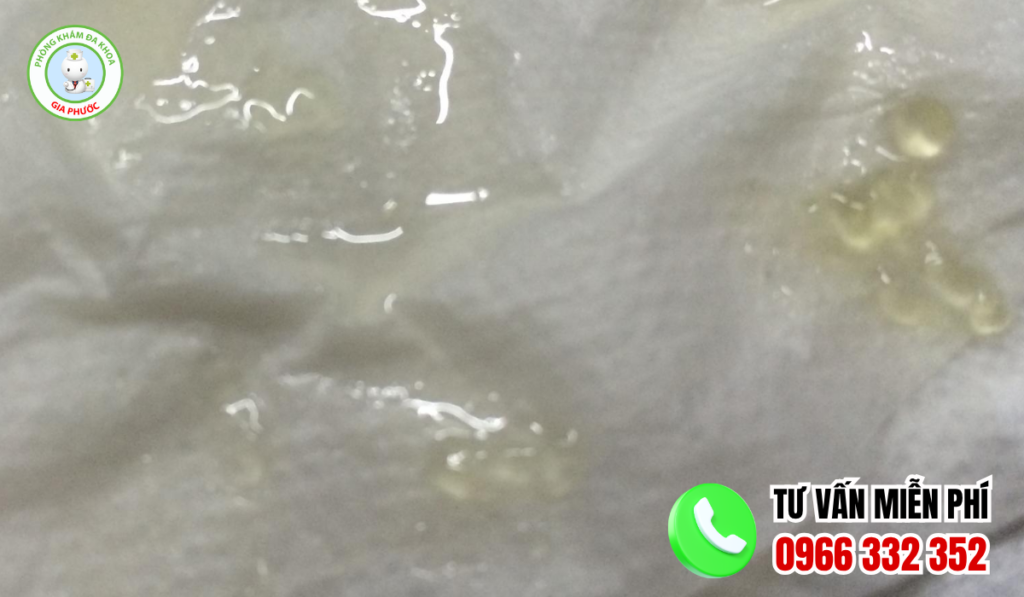 Hình ảnh tinh dịch vón cục