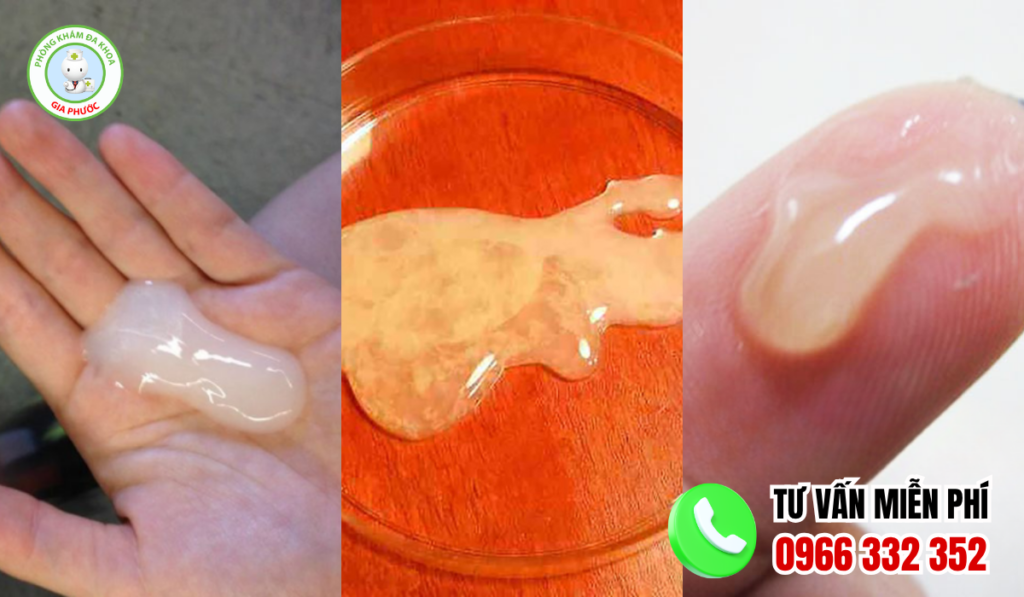 Hình ảnh tinh trùng vón cục như thạch thường gặp