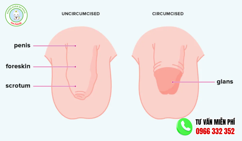 Hình ảnh trước và sau cắt bao quy đầu