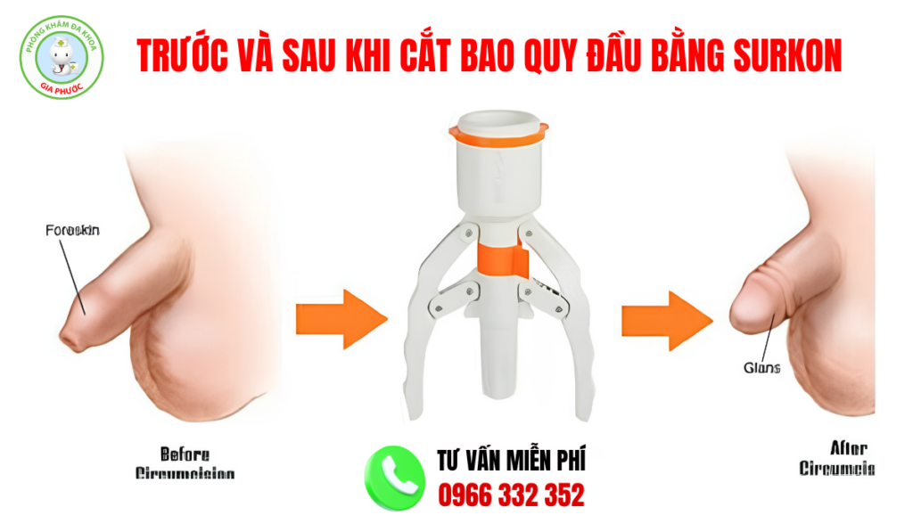 Hình ảnh trước và sau cắt bao quy đầu