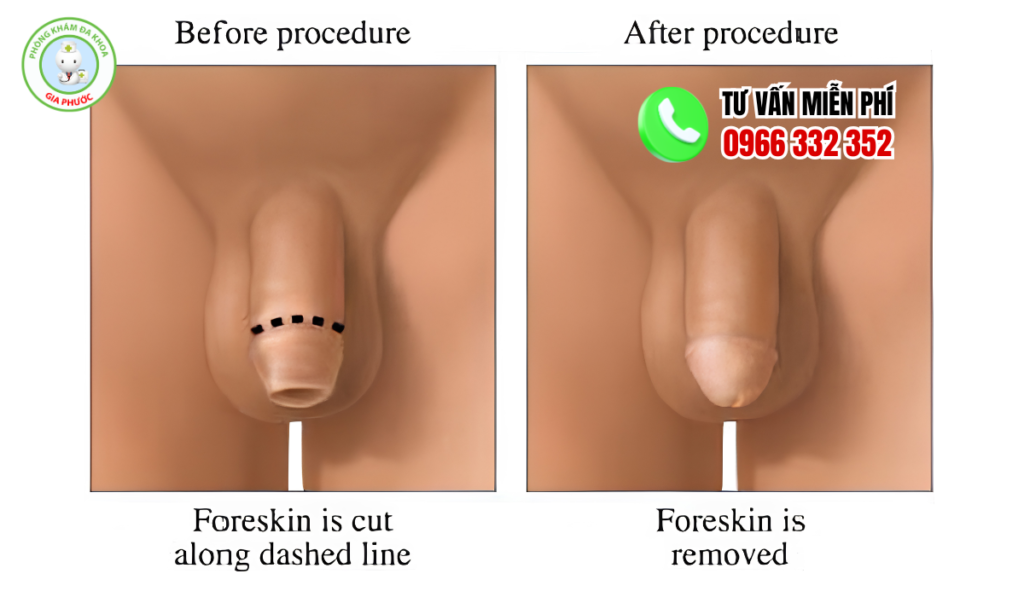 hình ảnh trước và sau khi cắt bao quy đầu