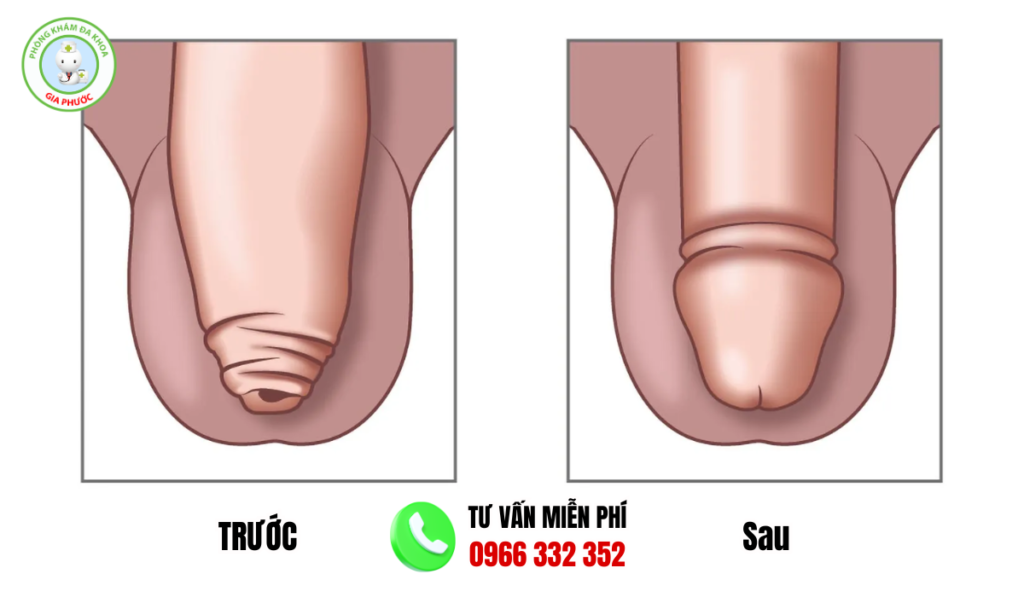 hình ảnh trước và sau khi cắt bao quy đầu
