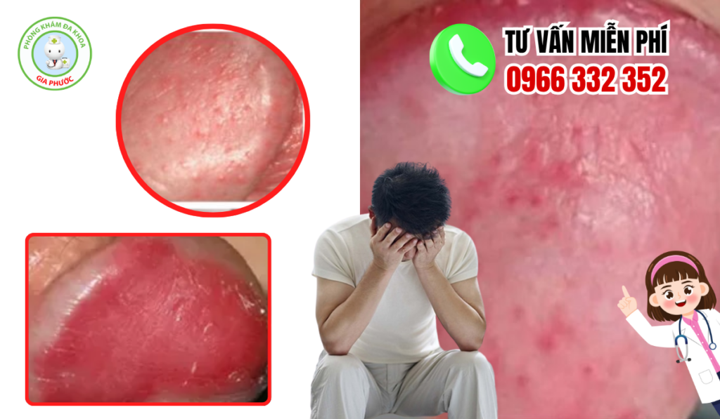 Hình Ảnh Viêm Bao Quy Đầu Ở Người Lớn
