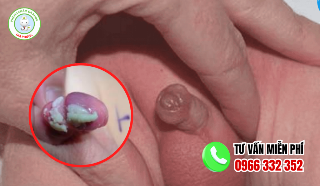 Hình Ảnh Viêm Bao Quy Đầu Ở Trẻ Nhỏ