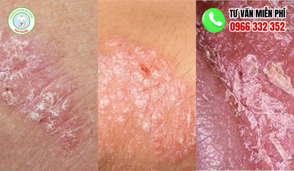 Tổng hợp hình ảnh ngứa vùng kín chi tiết