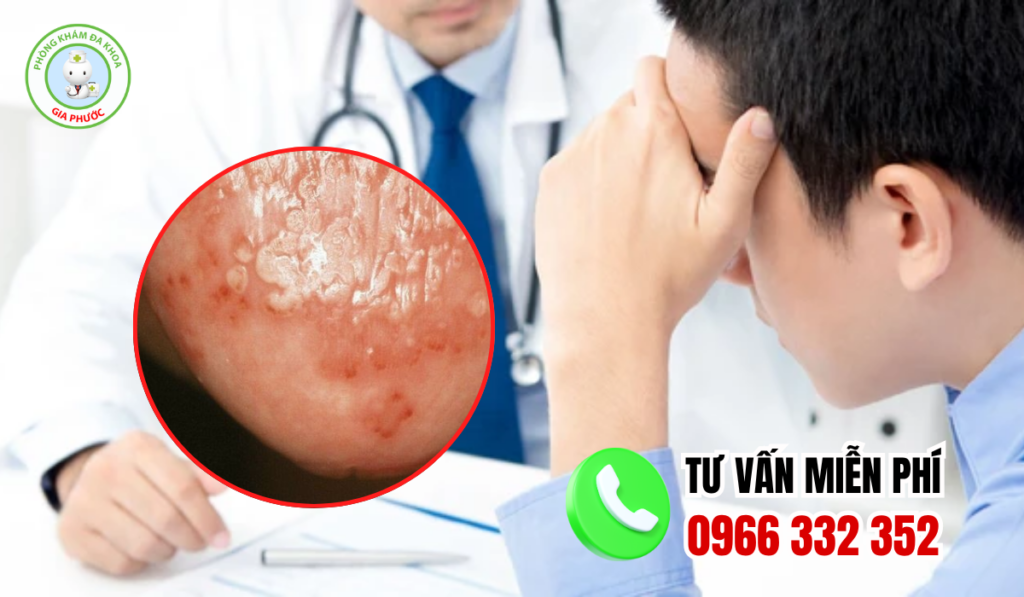 Tổng quan bệnh viêm bao quy đầu