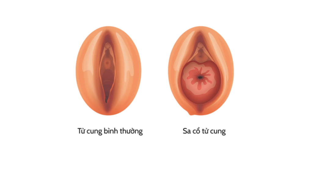 hình ảnh sa tử cung sau sinh